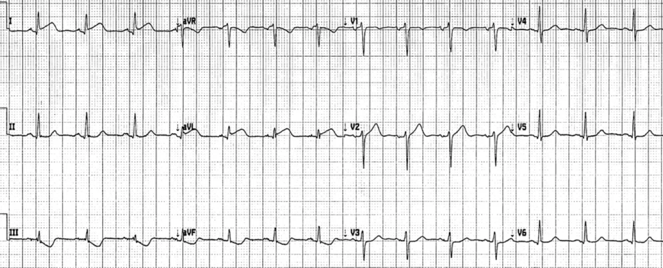 ECG