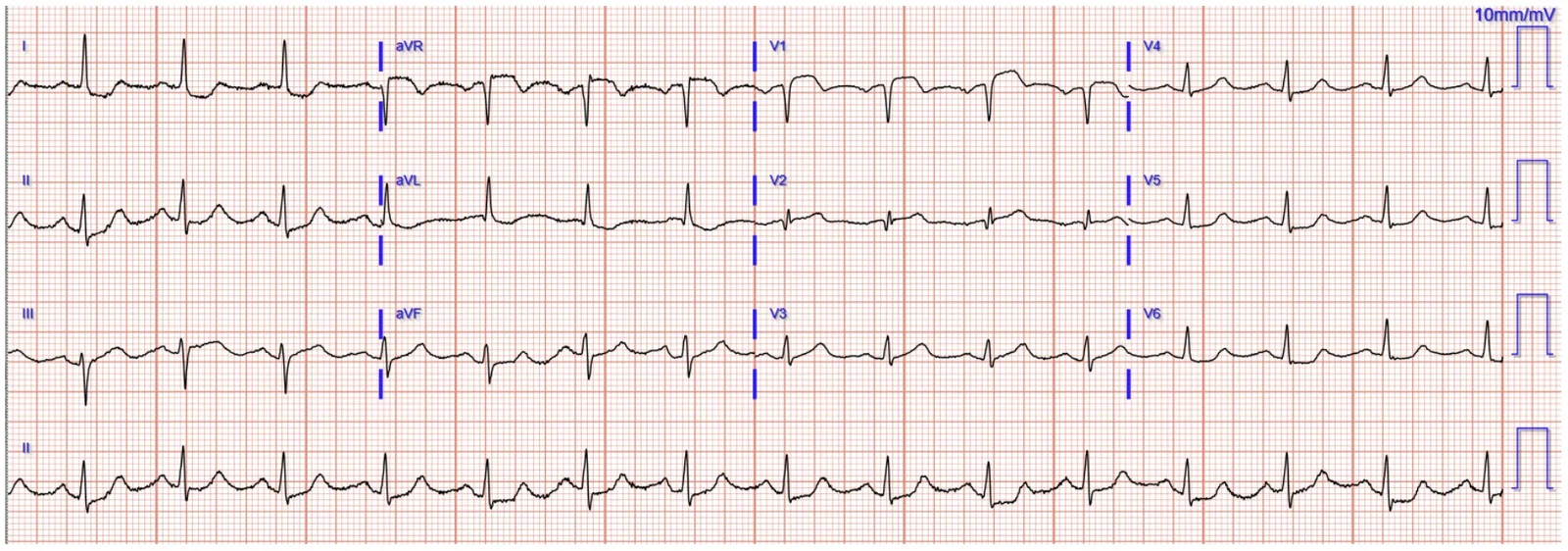 ECG