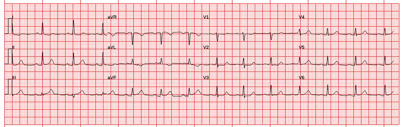 ECG