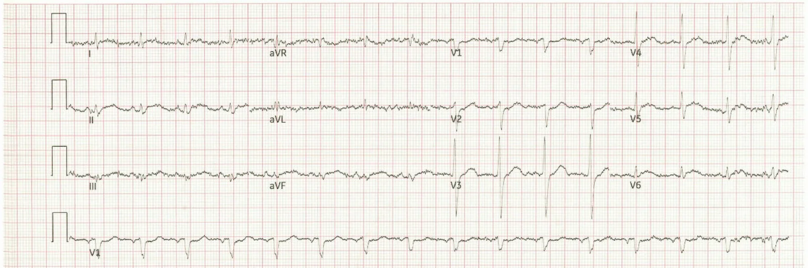 ECG