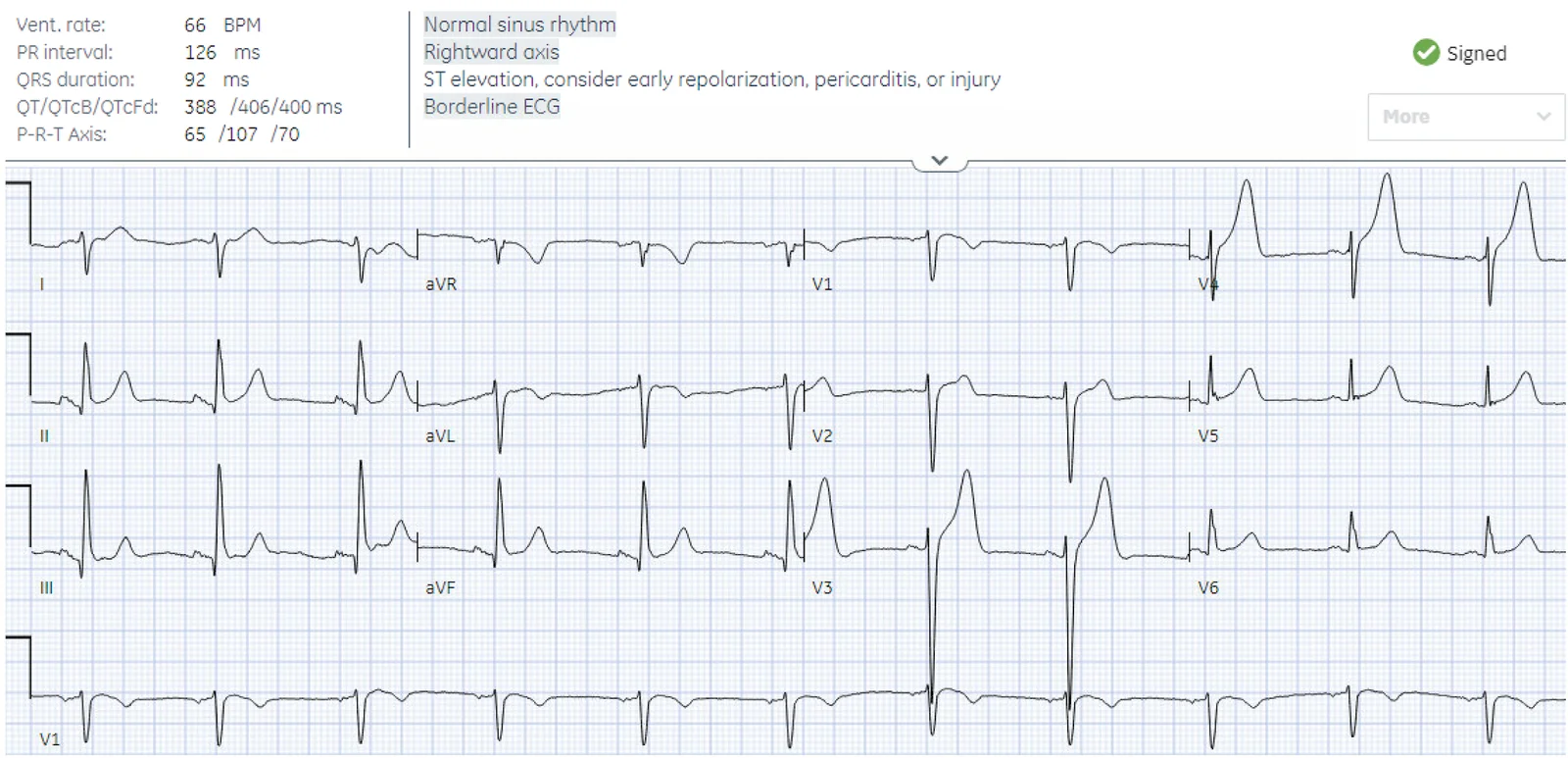 ECG