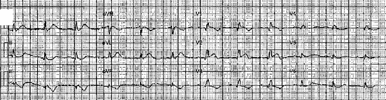 ECG