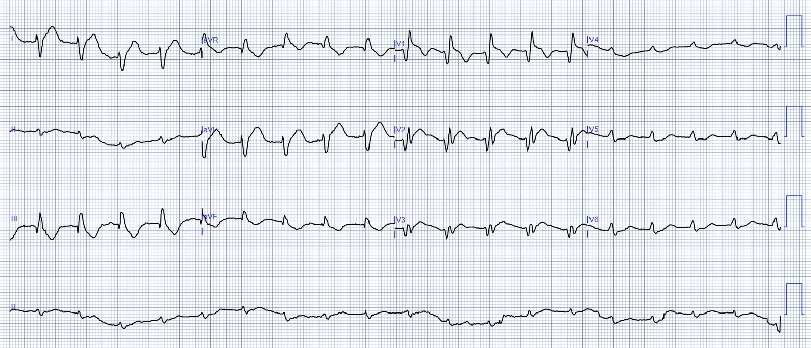 ECG