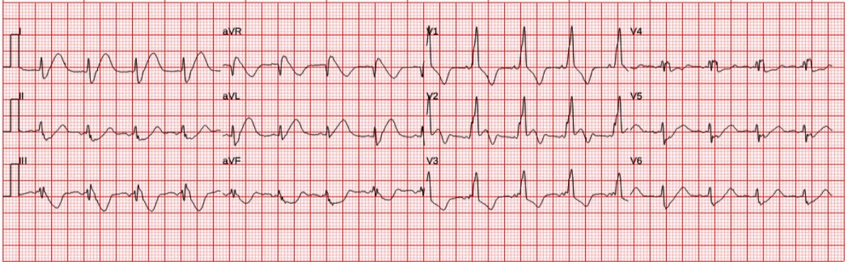 ECG