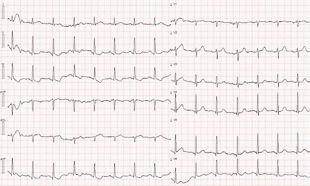 ECG