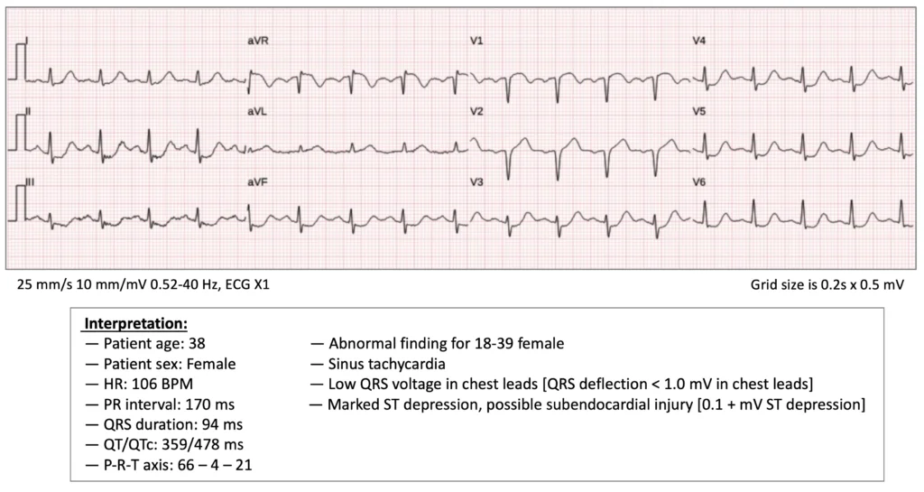 ECG