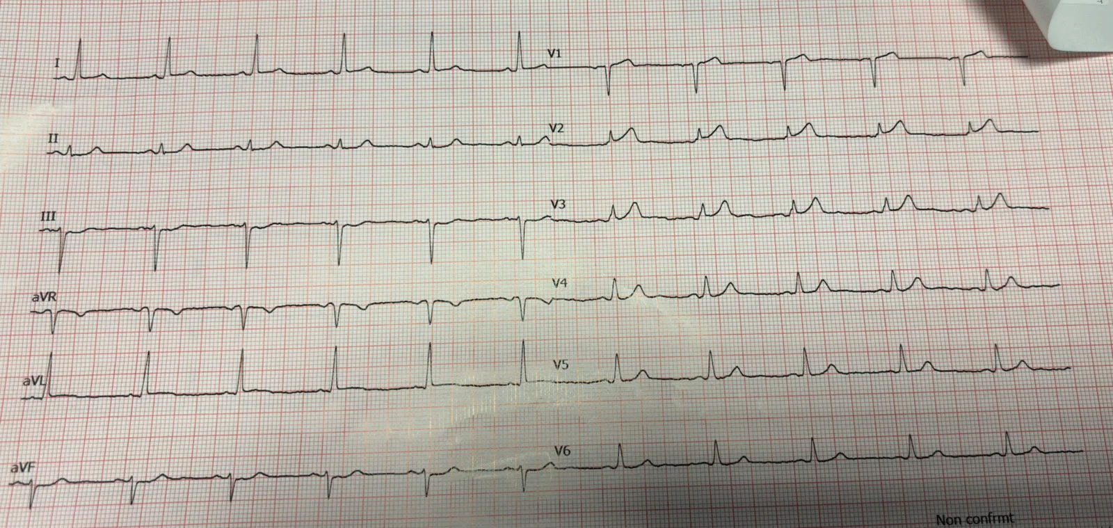 ECG