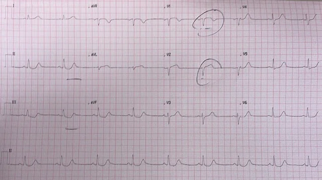 ECG