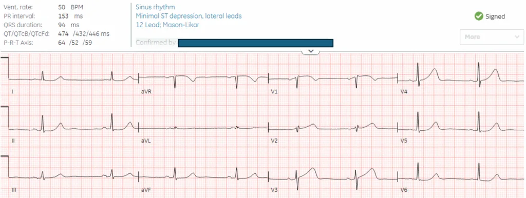 ECG