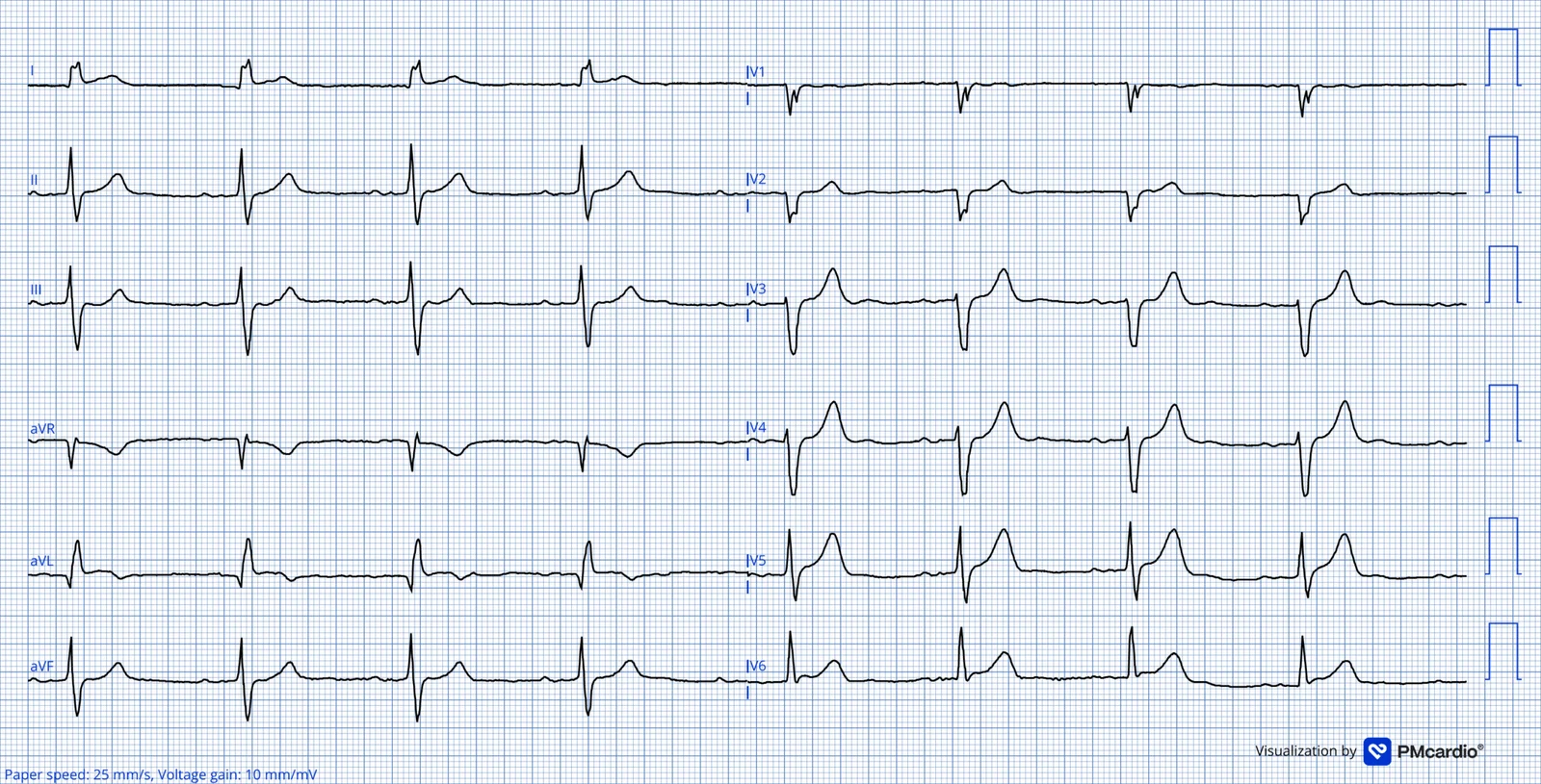 ECG