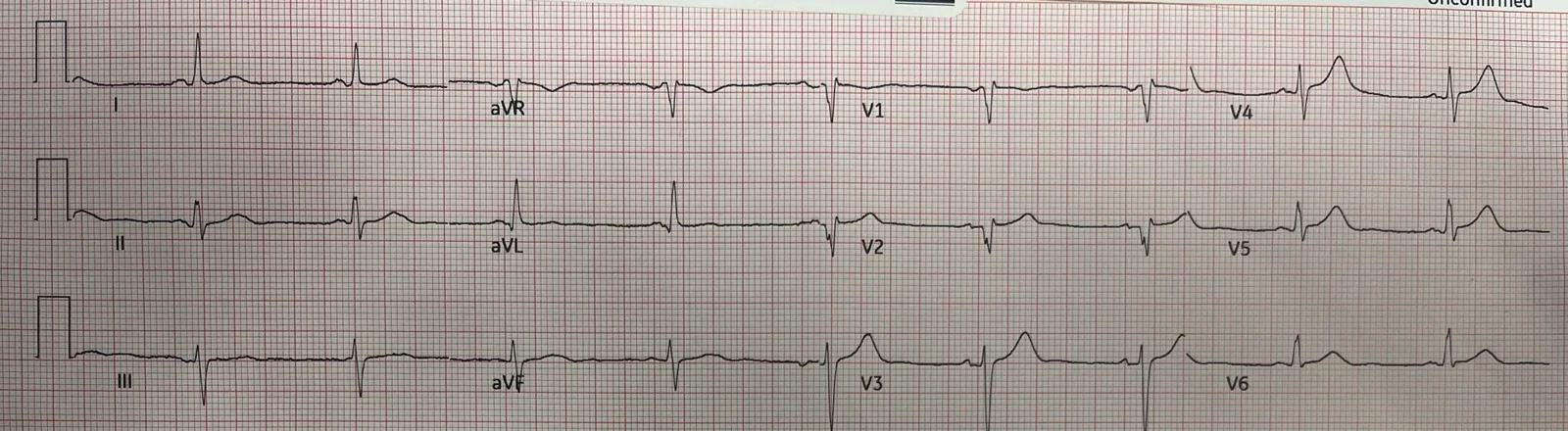ECG