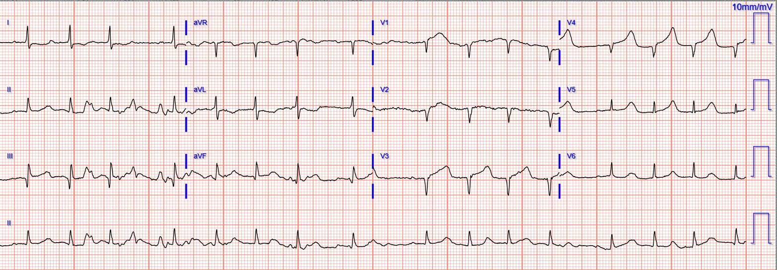 ECG