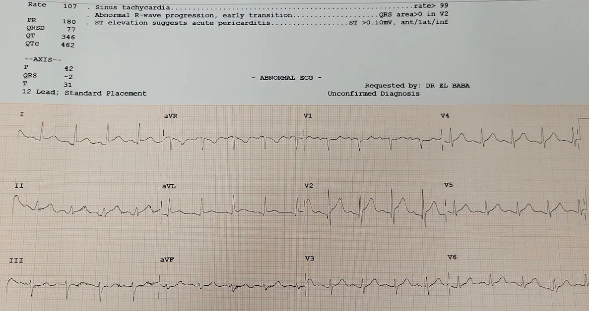 ECG