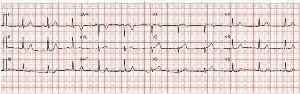 ECG