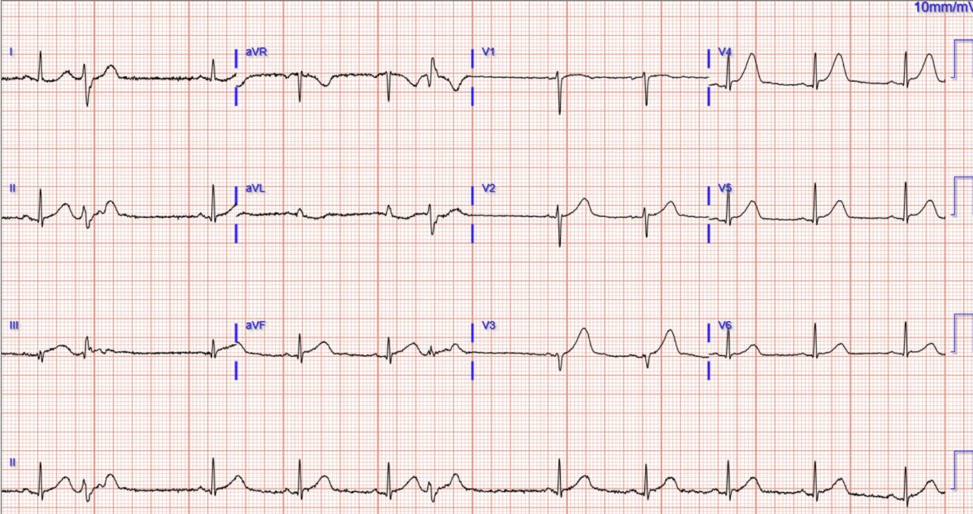 ECG