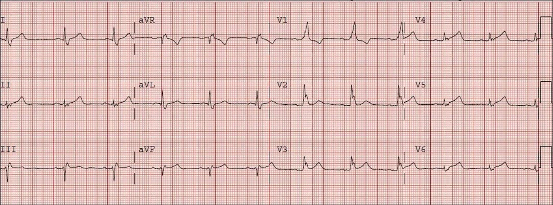 ECG
