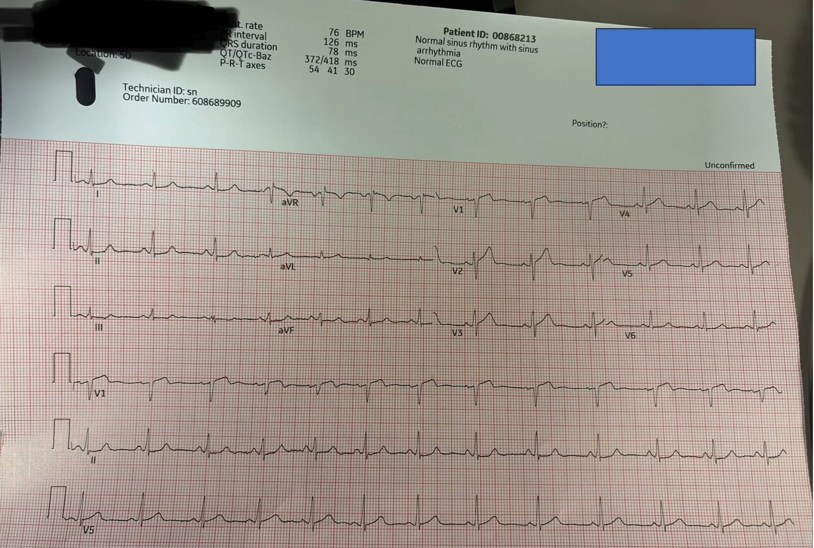 ECG