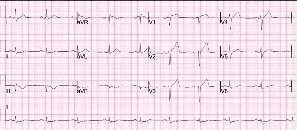 ECG