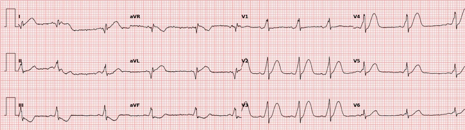 ECG