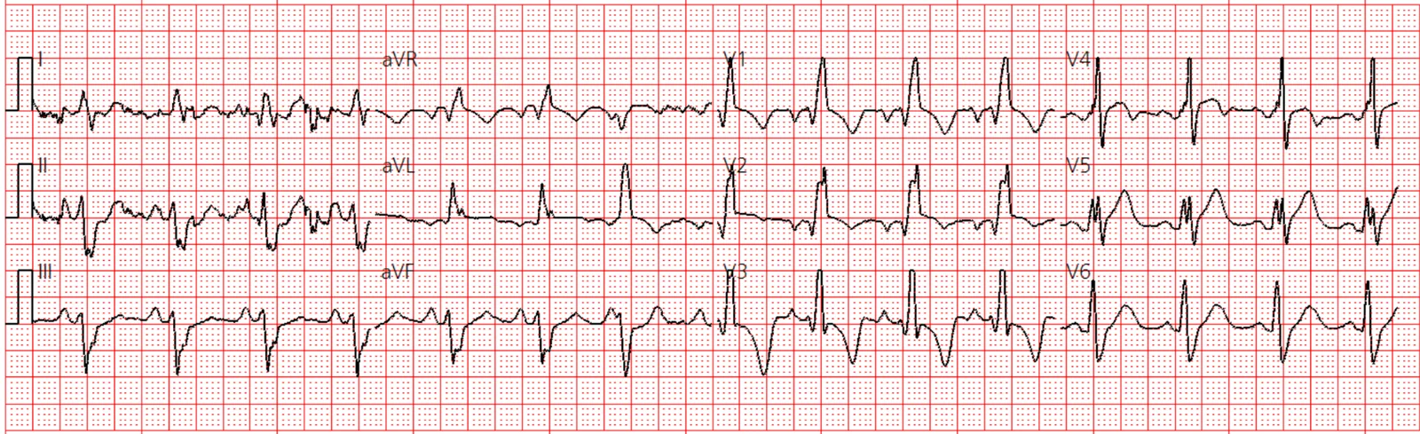 ECG