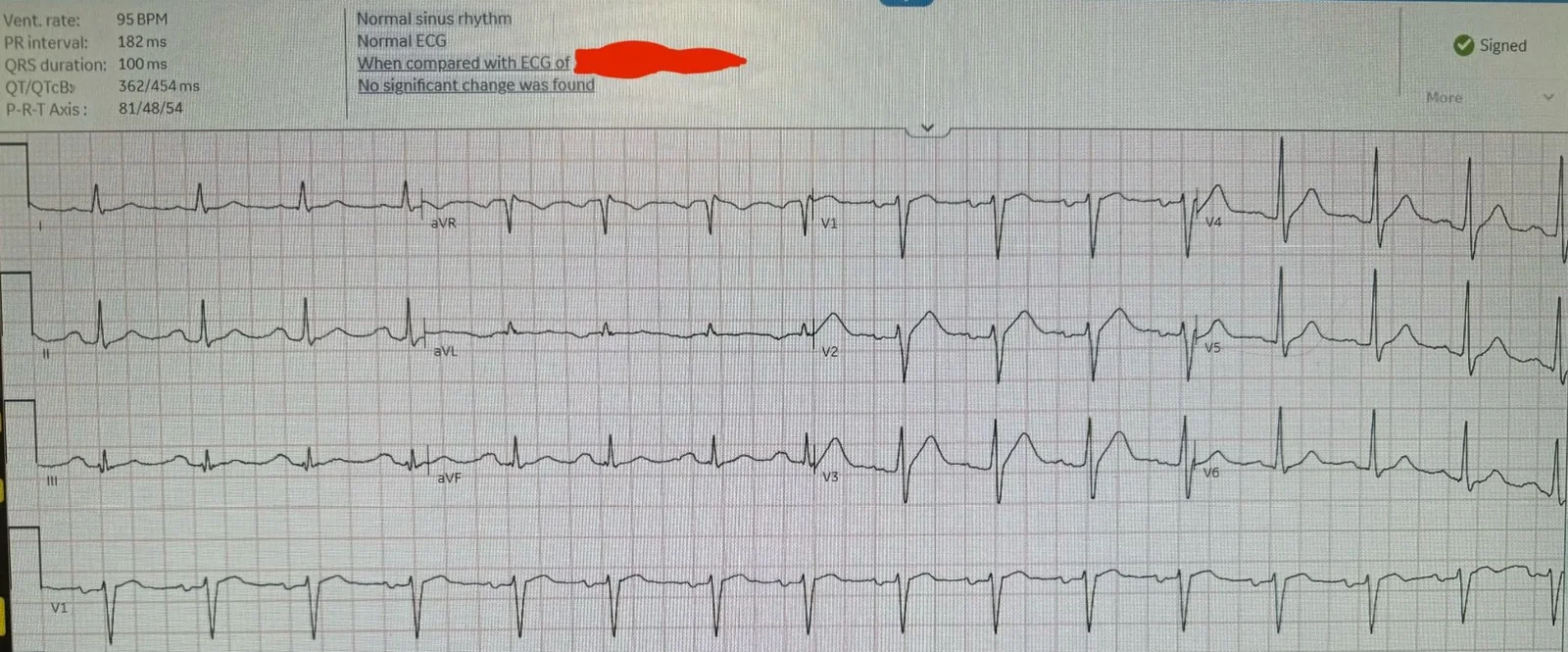 ECG