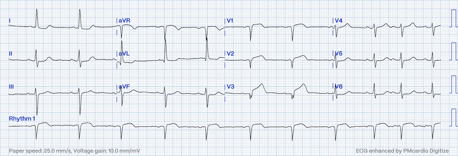 ECG