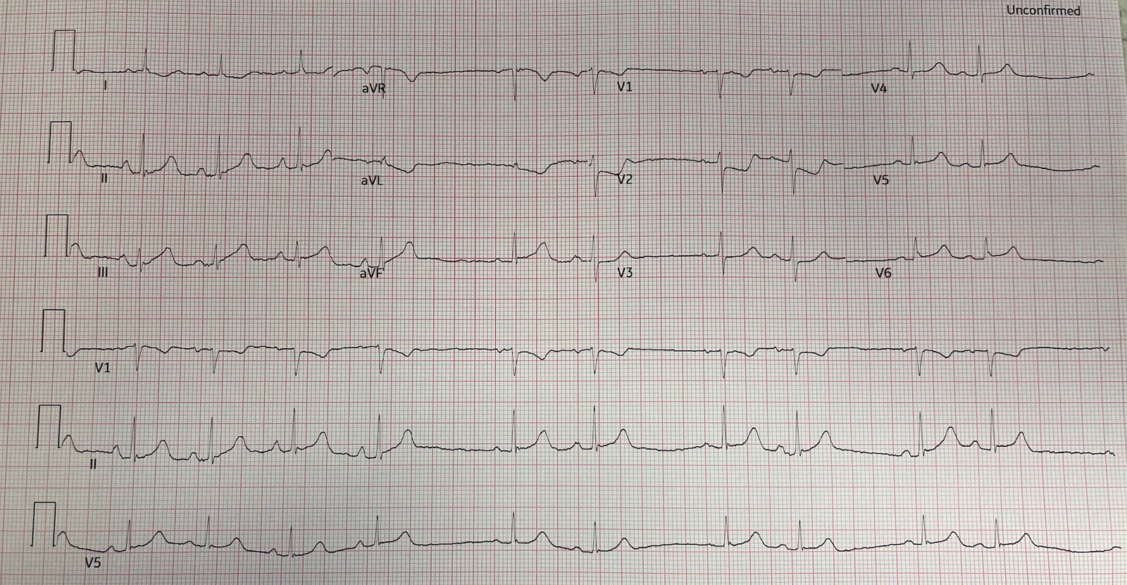 ECG