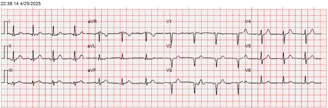 ECG