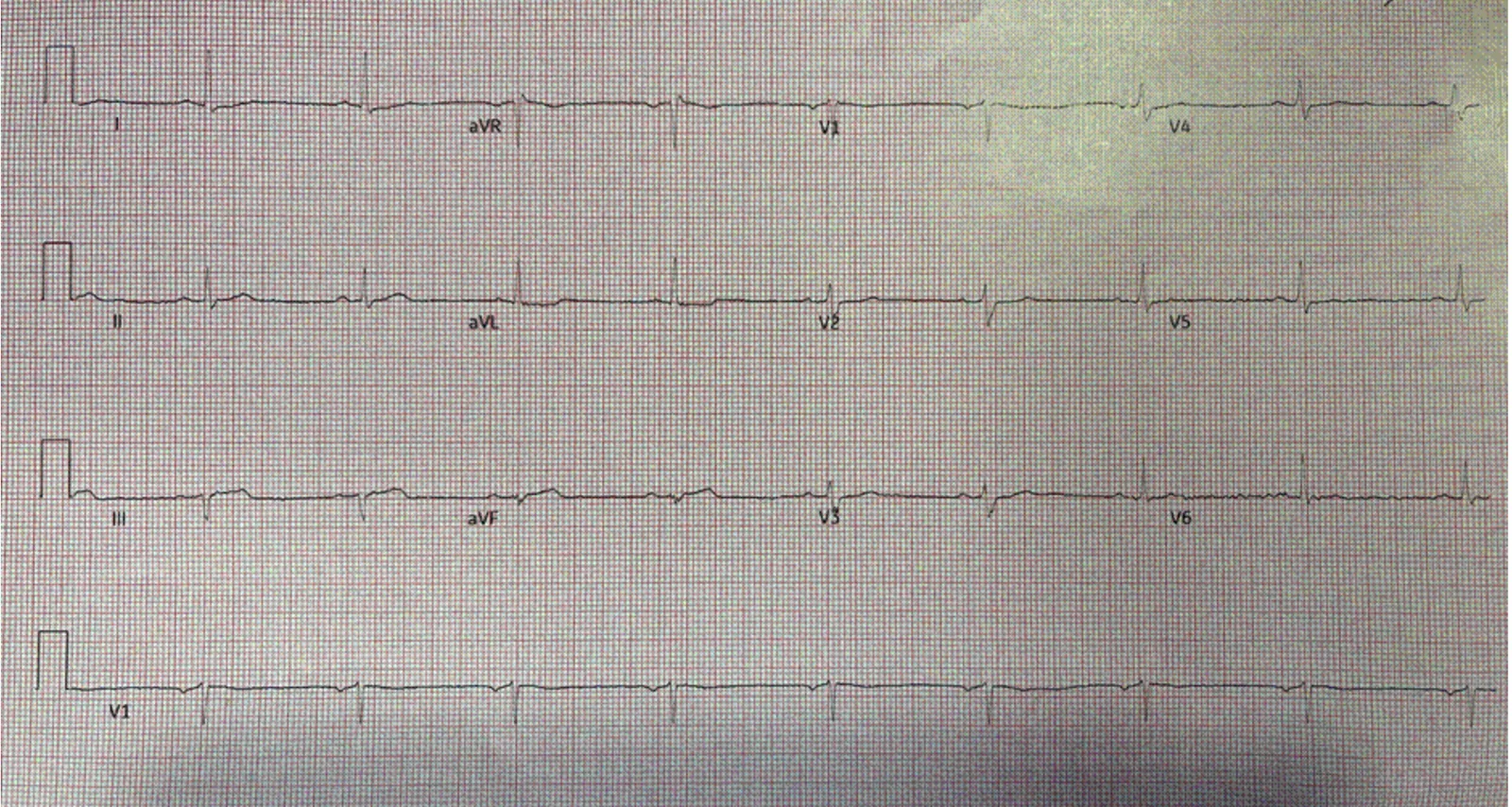 ECG