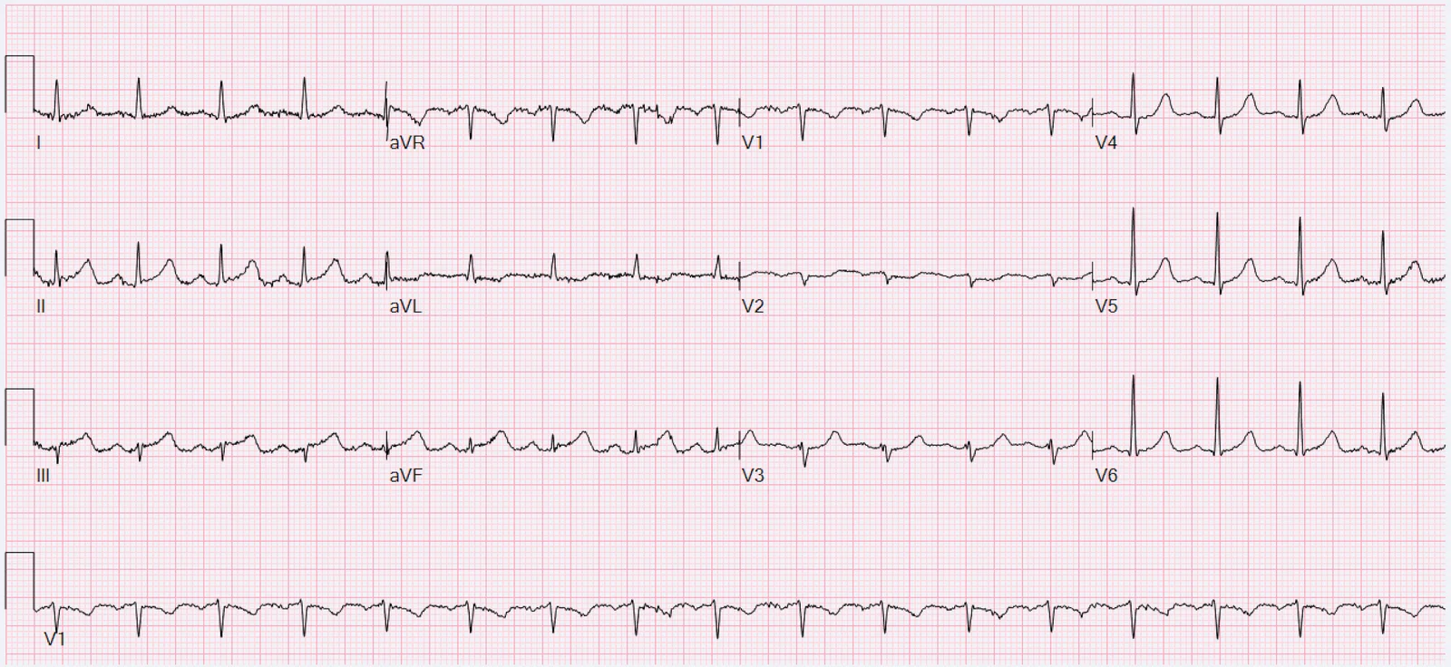 ECG