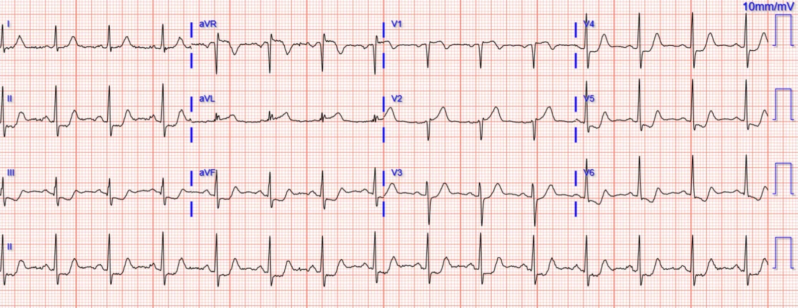 ECG