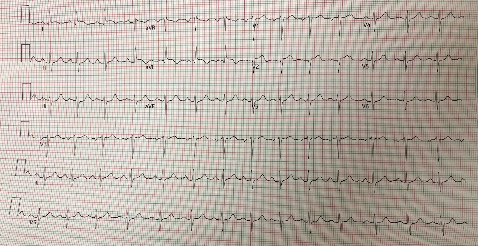 ECG