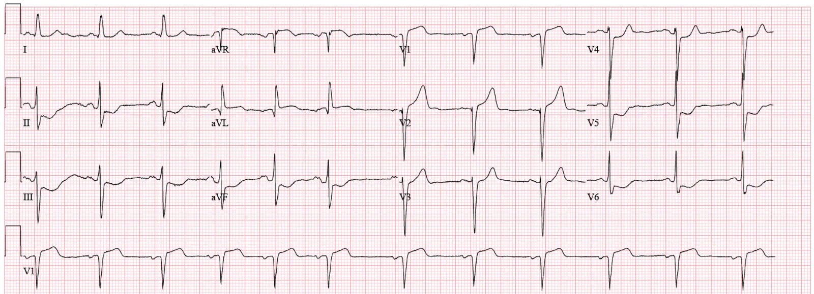 ECG