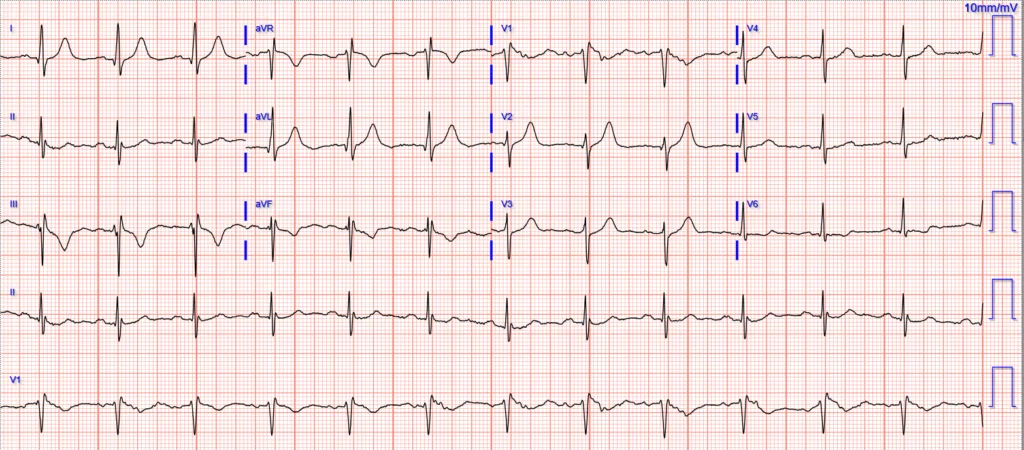 ECG