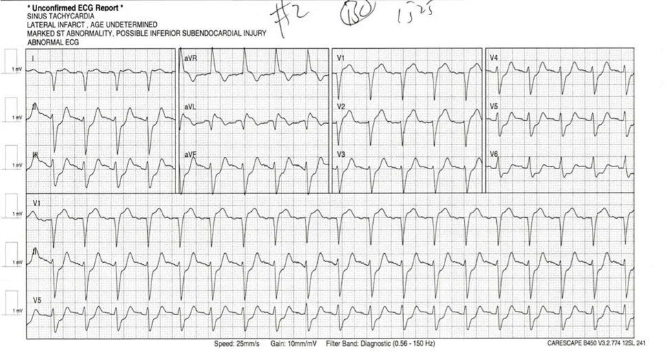ECG