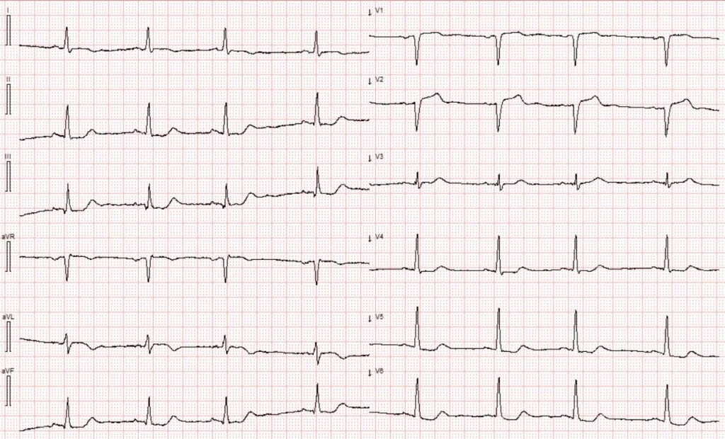 ECG